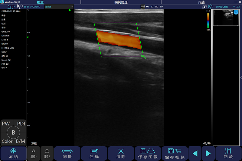 超声在血管外科中的应用