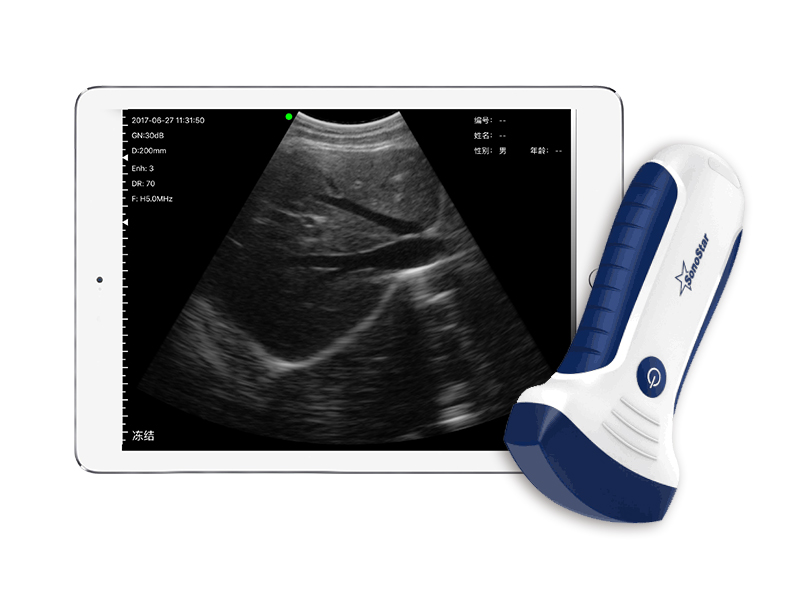 7C高配凸阵无线探头式掌上彩超